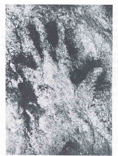 Prehistoric Cave Painting showing shortened little finger; Edelstein, 1986: p 87